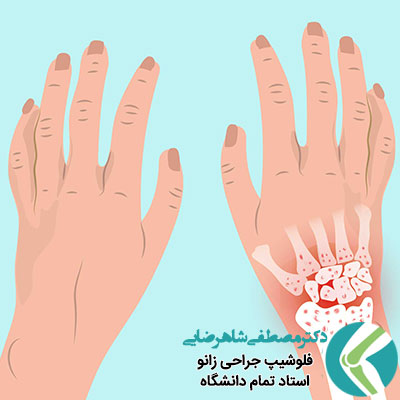 علت و درمان درد مچ دست