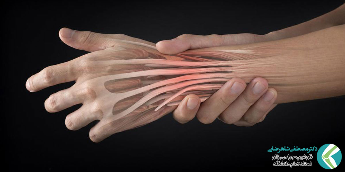 درمان پارگی تاندون دست