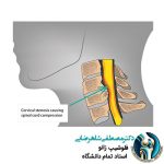 بیماری های نخاع گردنی چیست؟