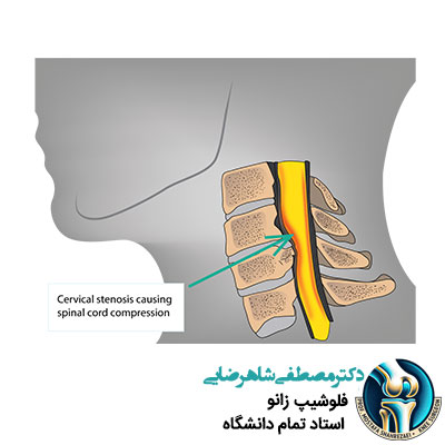 بیماری های نخاع گردنی چیست؟
