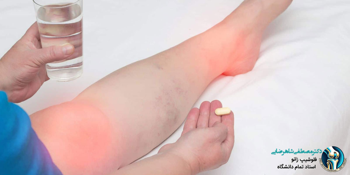 نقرس زانو چیست