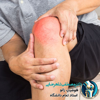 نقرس زانو چیست