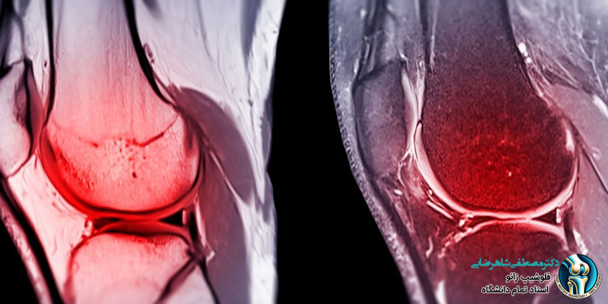 ام آر آی زانو