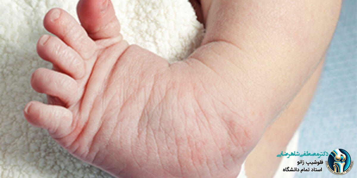 پاچنبری یا کلاب فوت چیست