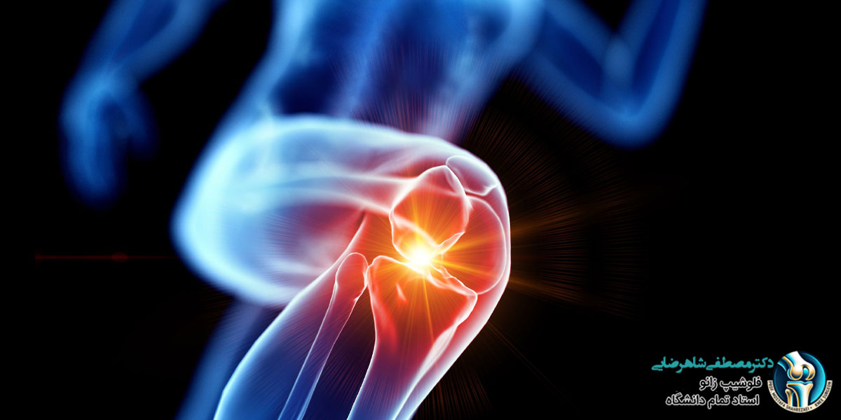 جراحی مینیسک زانو با لیزر در تهران
