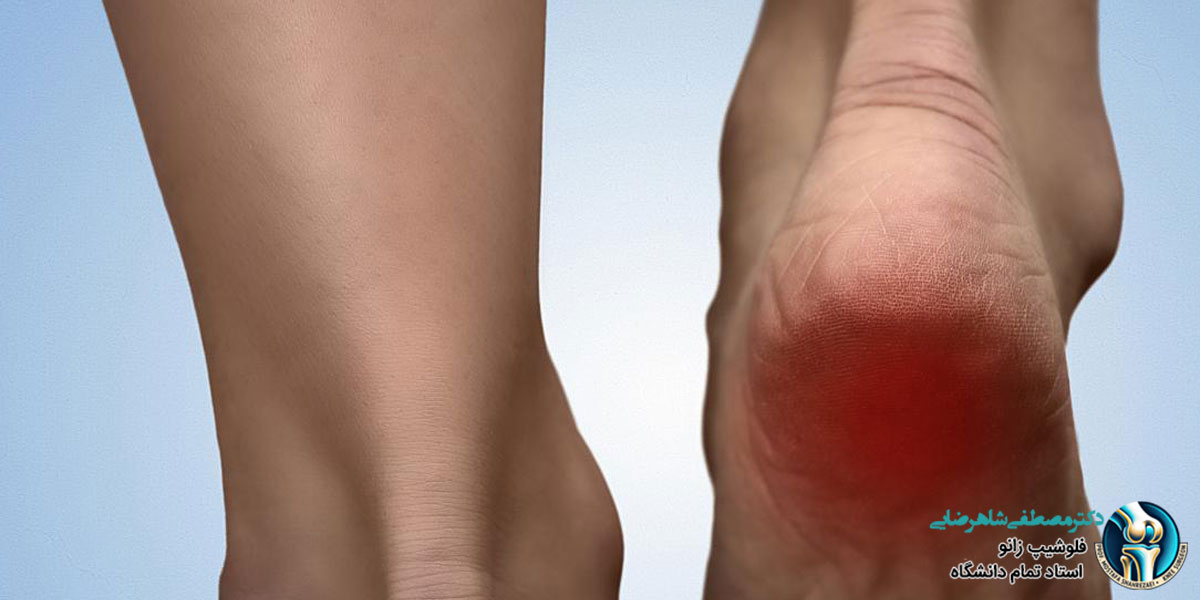 خار پاشنه چیست