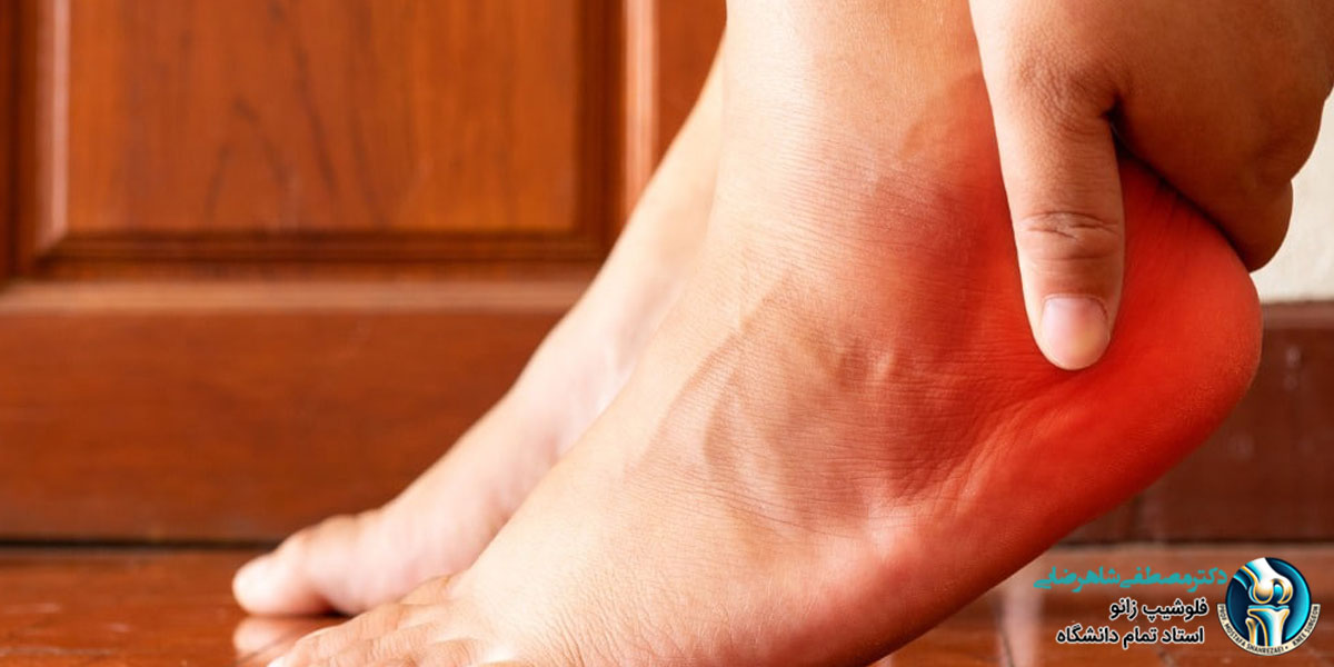 خار پاشنه چیست