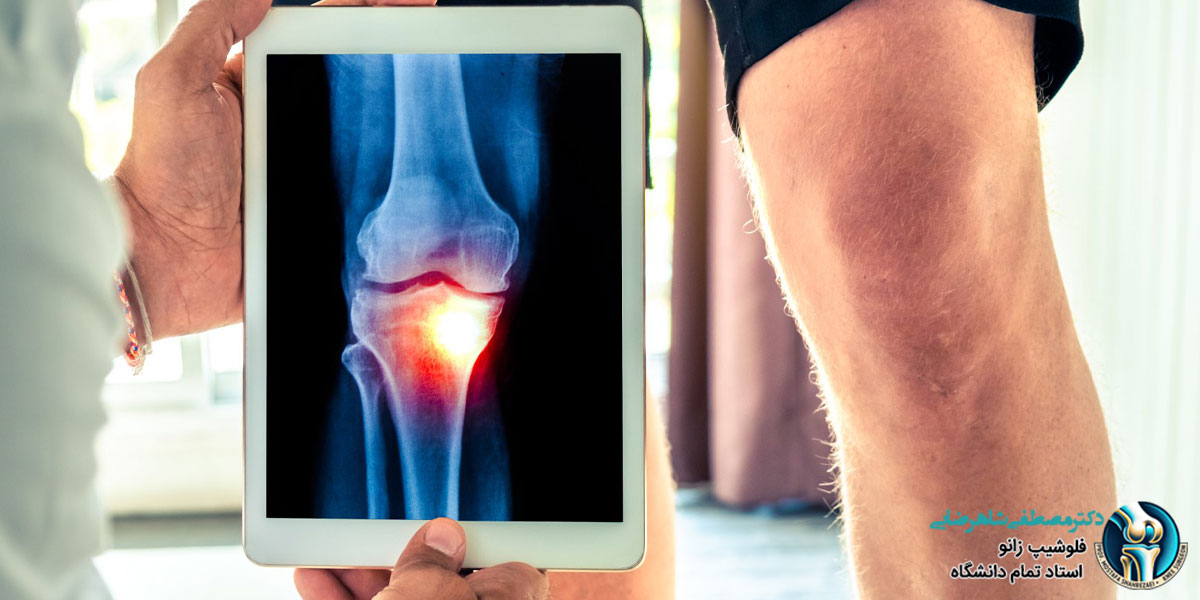 تشخیص آرتروز زانو با رادیوگرافی و سونوگرافی