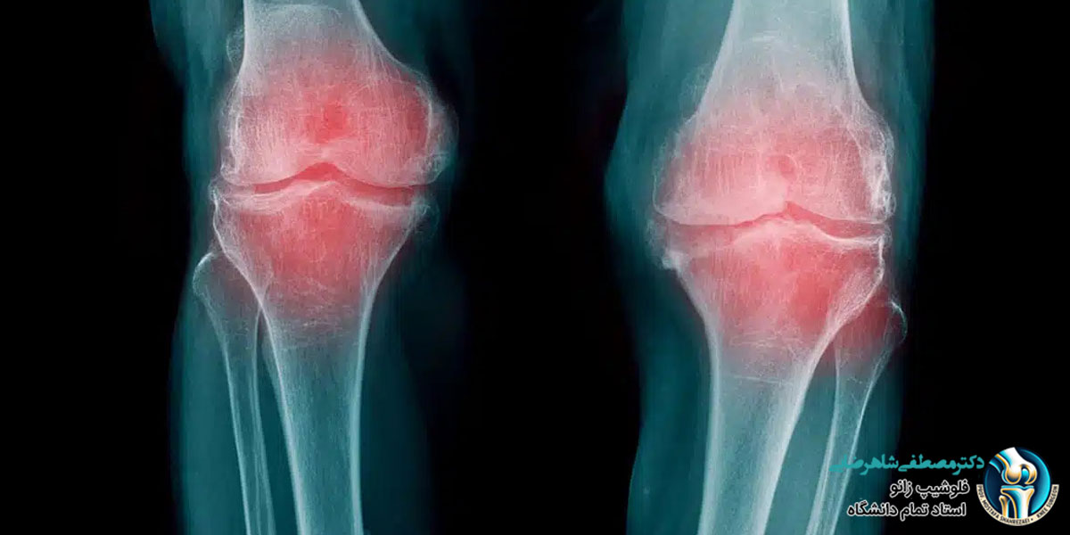 تشخیص آرتروز زانو با رادیوگرافی و سونوگرافی