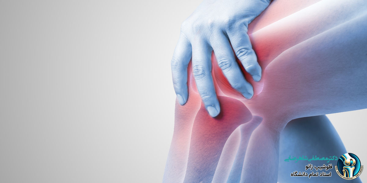 تشخیص آرتروز زانو با رادیوگرافی و سونوگرافی