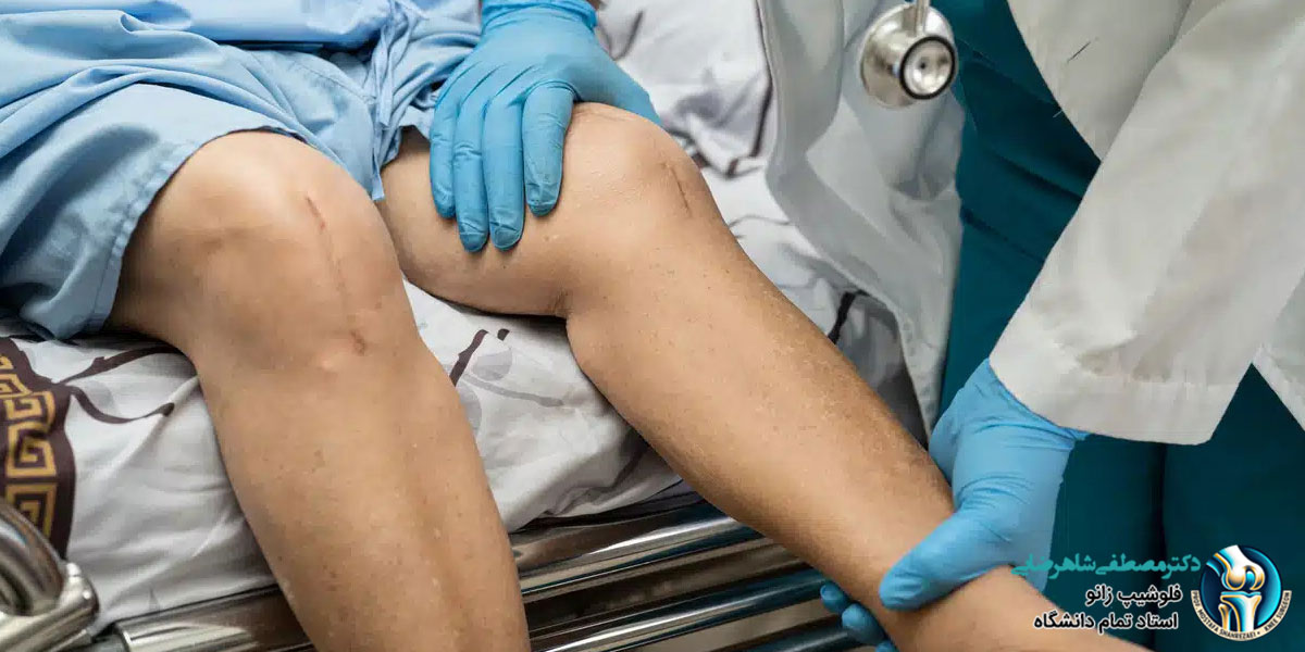 مزایای جراحی زانو به روش آرتروسکوپی