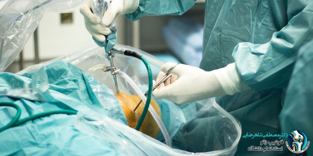 مزایای جراحی زانو به روش آرتروسکوپی