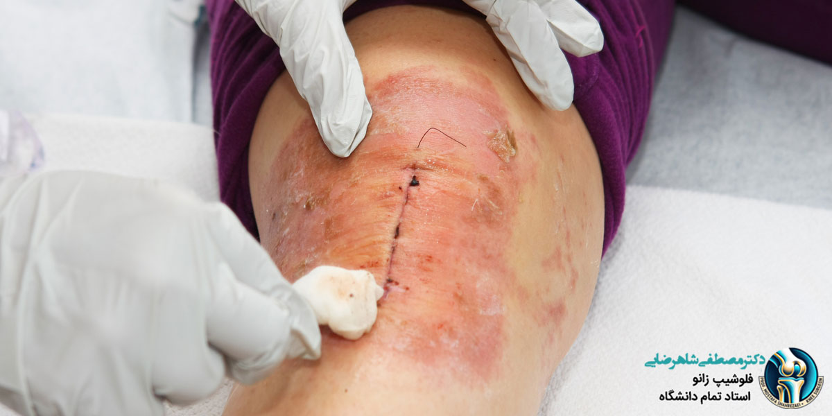 مراقبت از پانسمان محل جراحی تعویض مفصل زانو