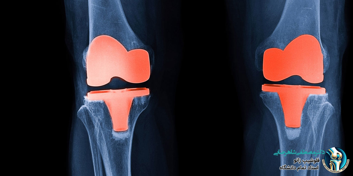 عمر مفید پروتزهای زانو