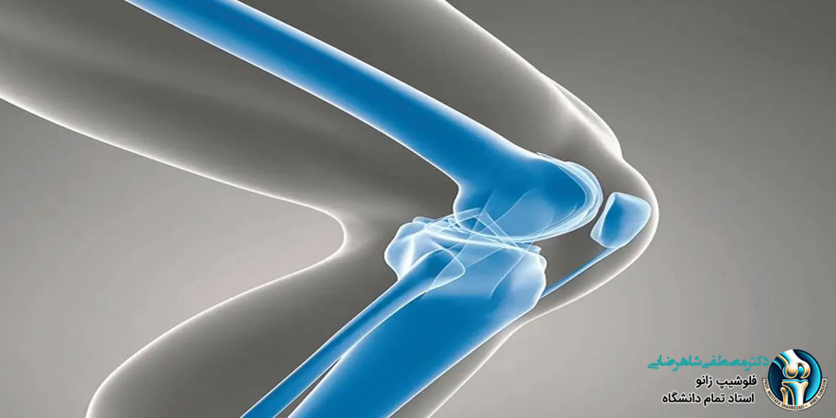 عمر مفید پروتزهای زانو