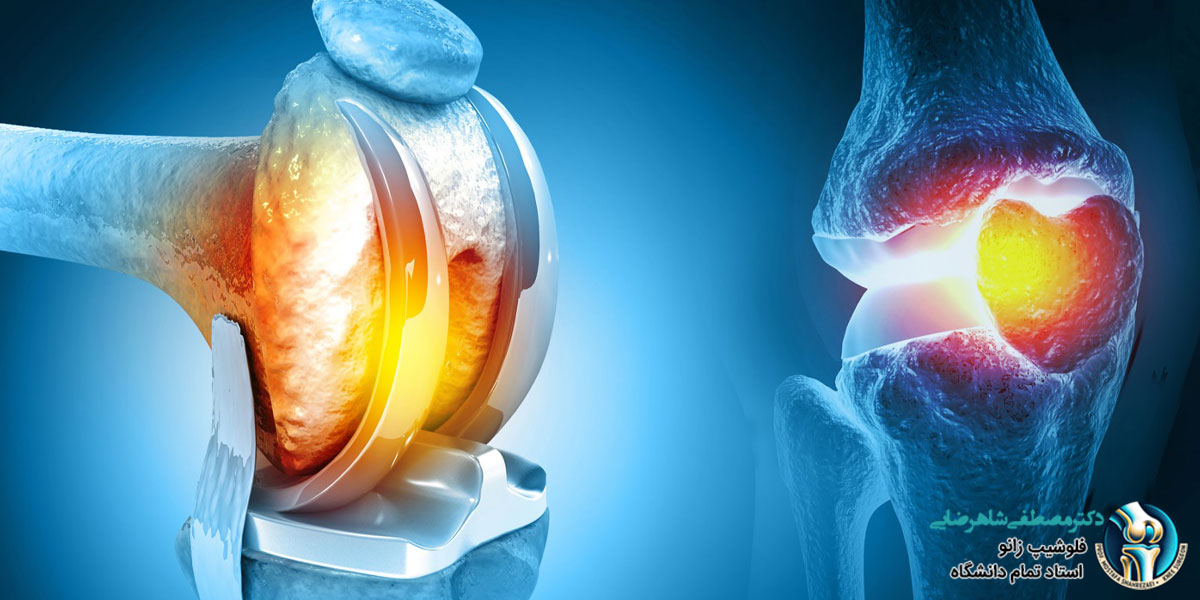 تعویض مفصل زانو چه زمانی انجام می شود