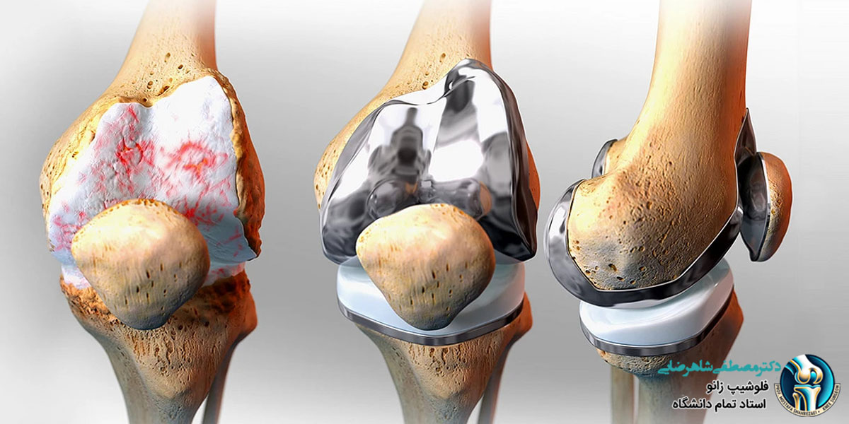 تعویض مفصل زانو چه زمانی انجام می شود