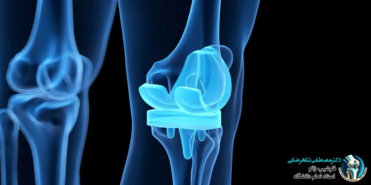 تعویض مفصل زانو چه زمانی انجام می شود