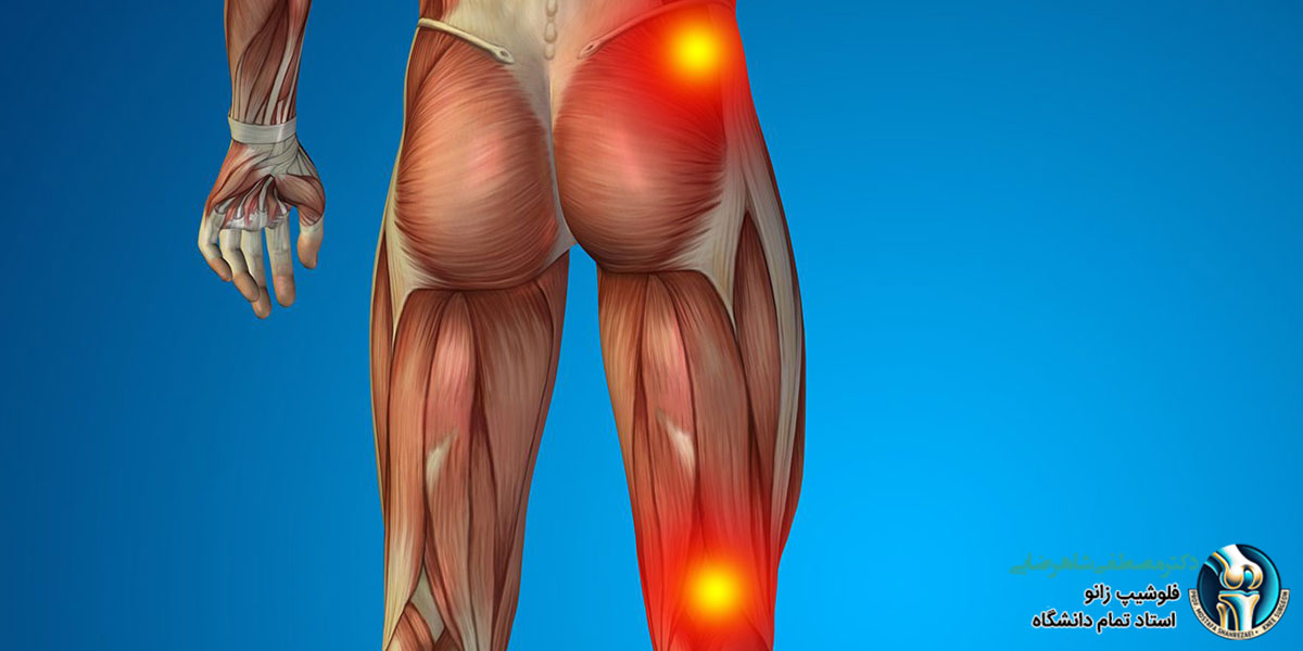 آیا سیاتیک باعث درد زانو می شود