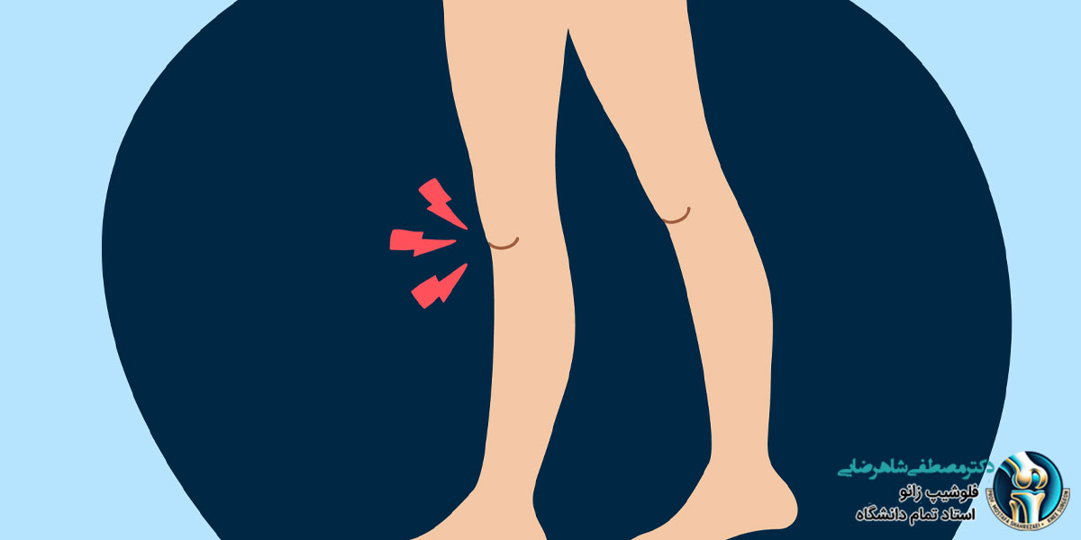 علت رگ به رگ شدن عضلات زانو