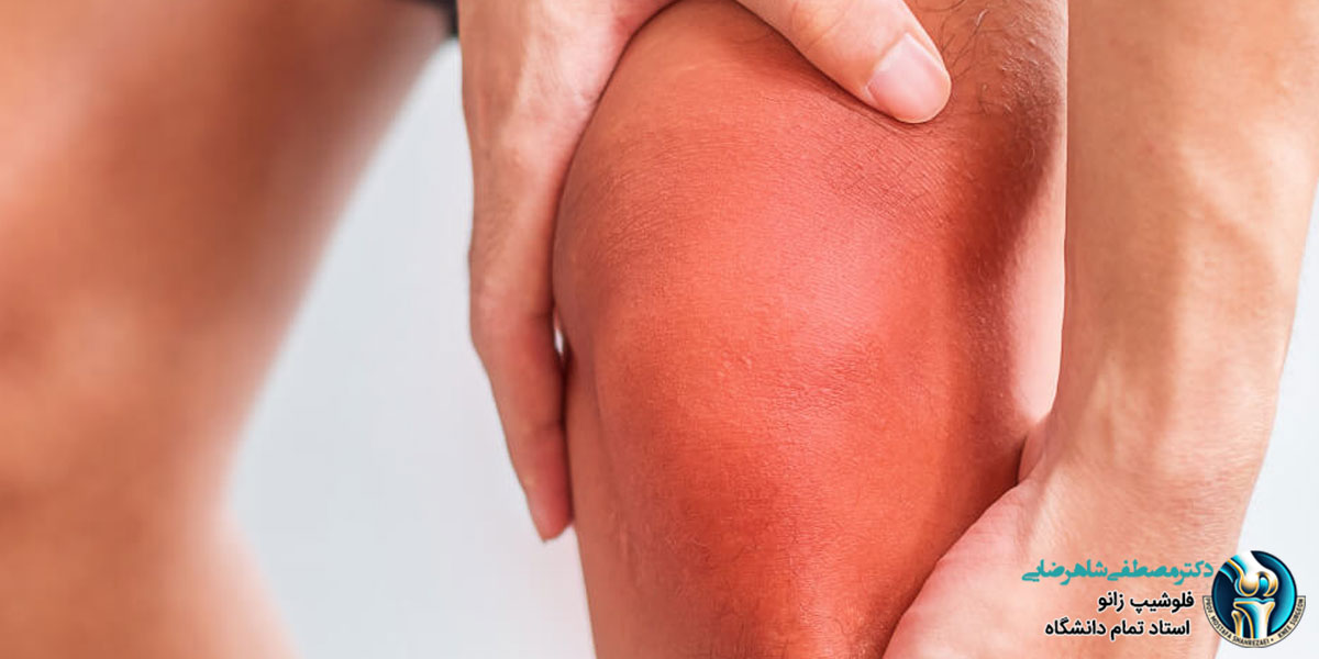 علائم بیماری های زانو