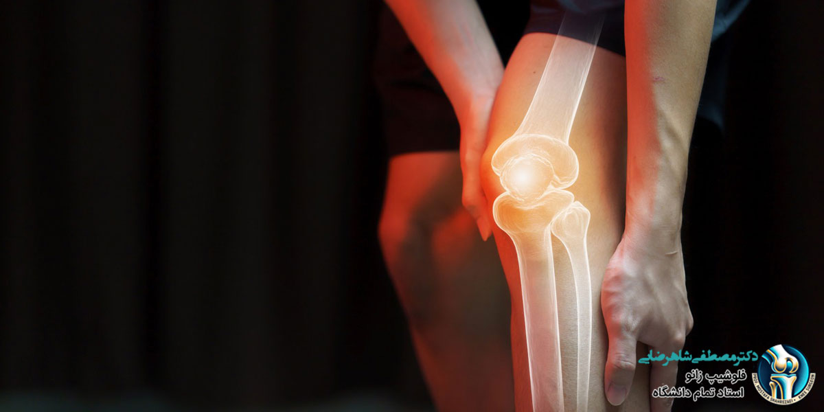 شایع ترین درد مفصل زانو در ورزشکاران