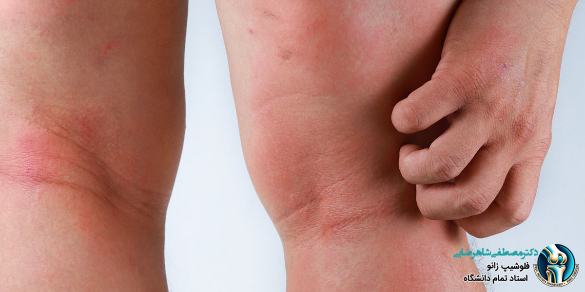علت خارش زانو چیست