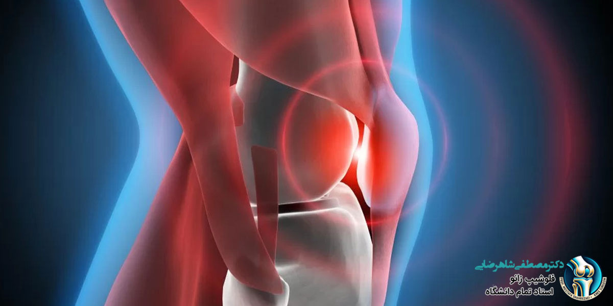 ملاحظات لازم جهت جراحی زانو