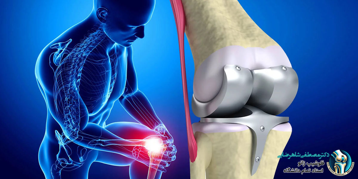 ملاحظات لازم جهت جراحی زانو