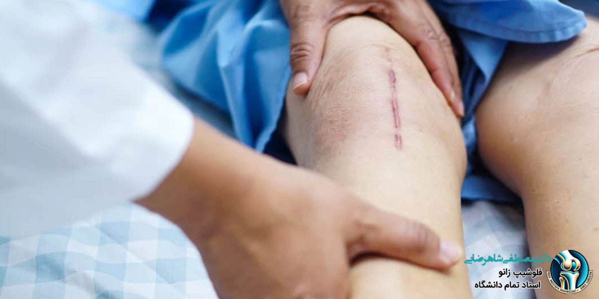 مراقبتهای قبل از جراحی زانو