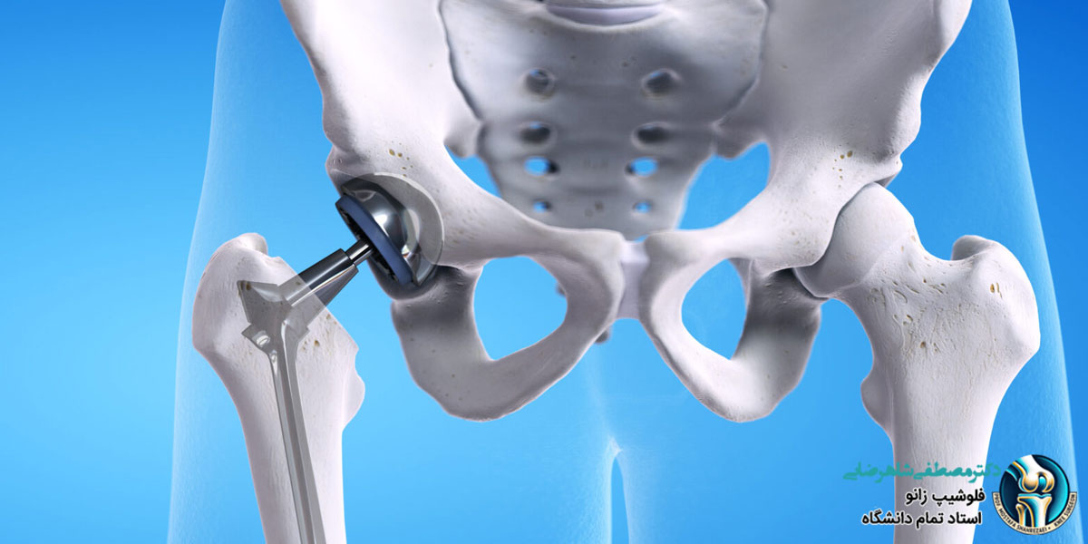 بهترین کاندیدا برای جراحی تعویض مفصل لگن