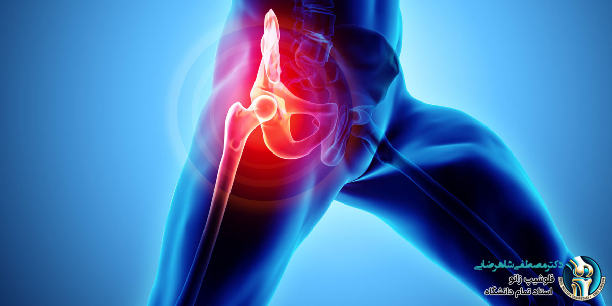 بهترین کاندیدا برای جراحی تعویض مفصل لگن