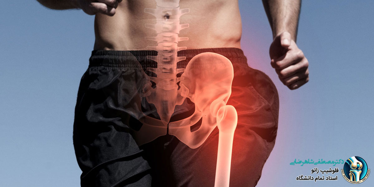 بهترین کاندیدا برای جراحی تعویض مفصل لگن