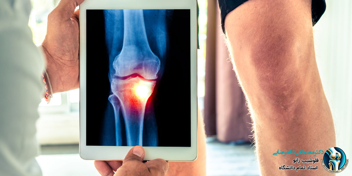 آمادگی های لازم جهت درمان رباط صلیبی