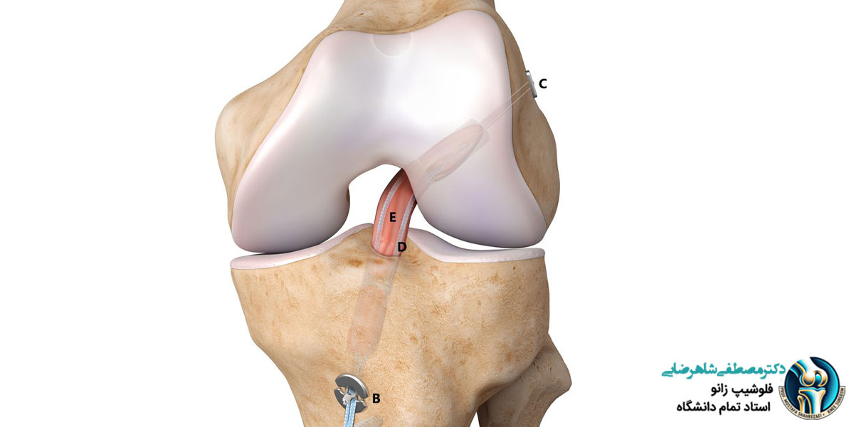 آمادگی های لازم جهت درمان رباط صلیبی