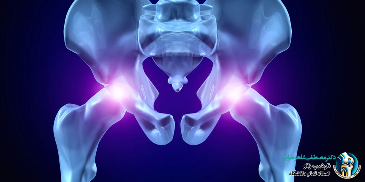 زمان بهبودی بعد از جراحی تعویض مفصل لگن
