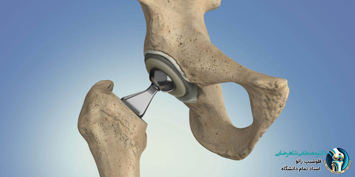 زمان بهبودی بعد از جراحی تعویض مفصل لگن