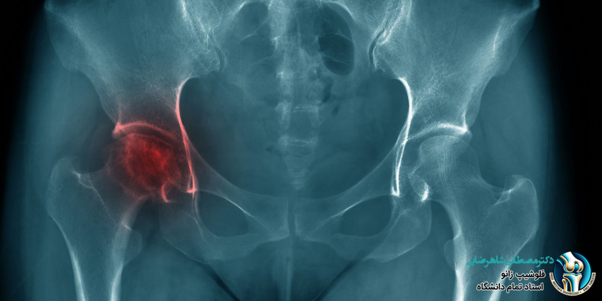 زمان بهبودی بعد از جراحی تعویض مفصل لگن