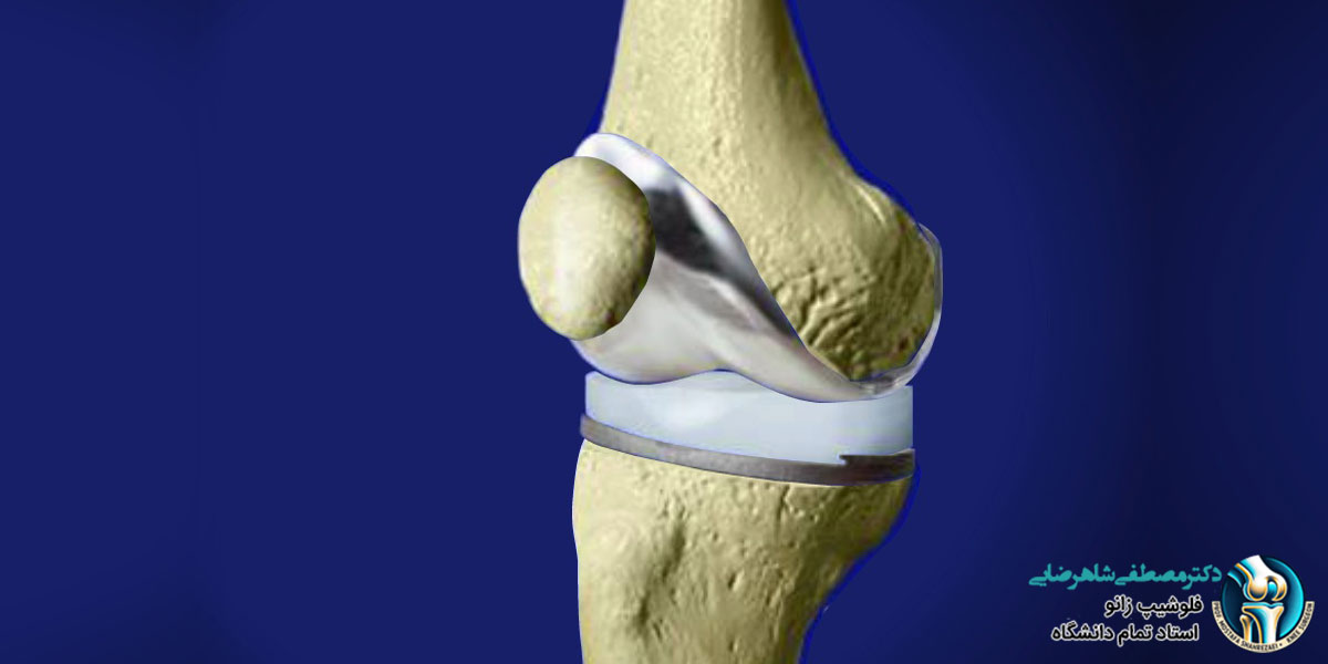 تفاوت آرتروسکوپی زانو و تعویض مفصل