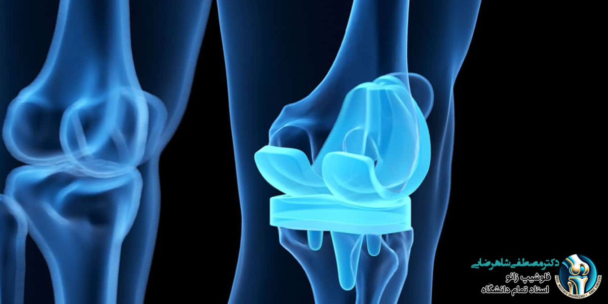 تفاوت آرتروسکوپی زانو و تعویض مفصل