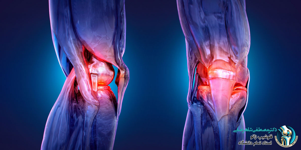 آیا تعویض مفصل زانو درد دارد