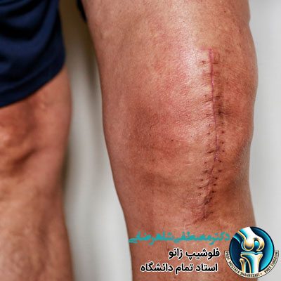 آیا تعویض مفصل زانو درد دارد