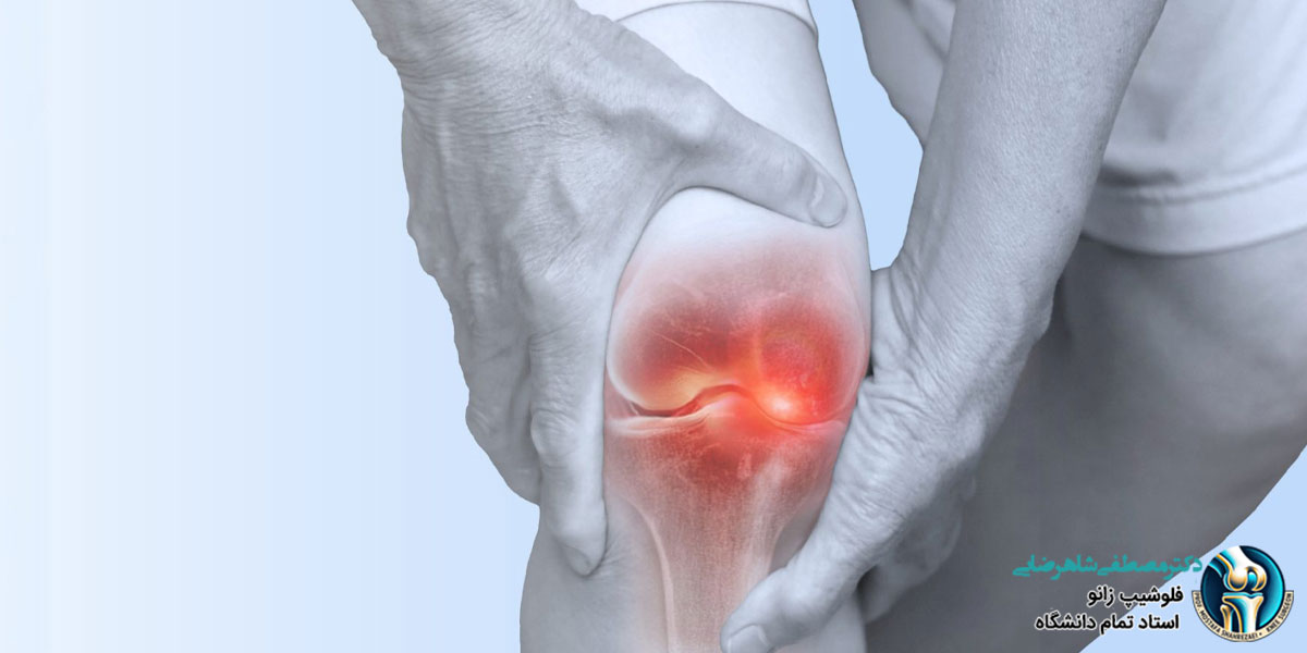 علائم هشداردهنده آرتروز زانو