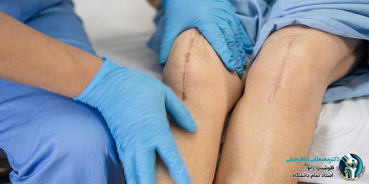 زانوی مصنوعی چقدر عمر می کند