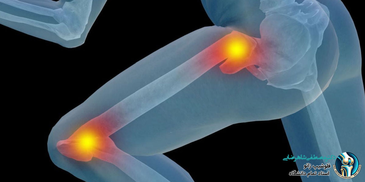 زانو درد و لگن درد، اول کدام مورد باید جراحی شود