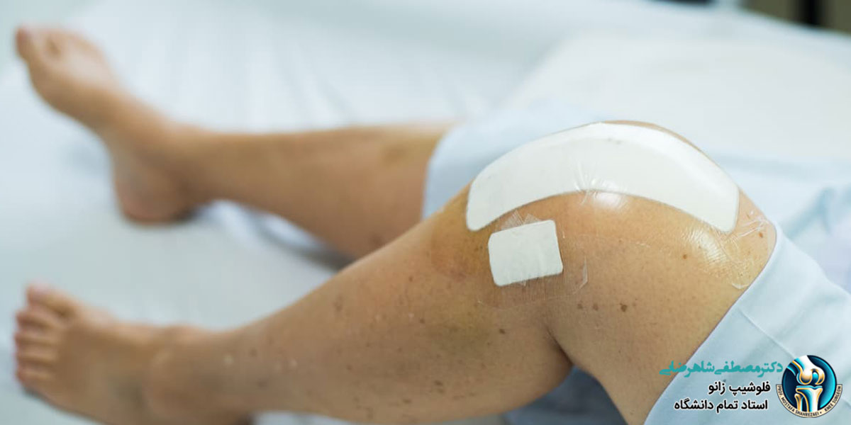 درد دوباره زانو بعد از جراحی