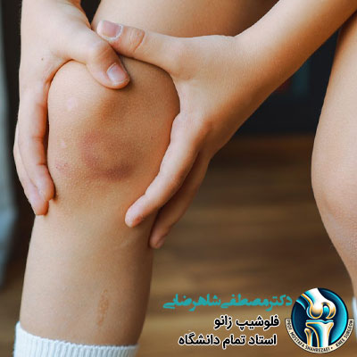 چرا جوان ها هم دچار آرتروز زانو می شوند