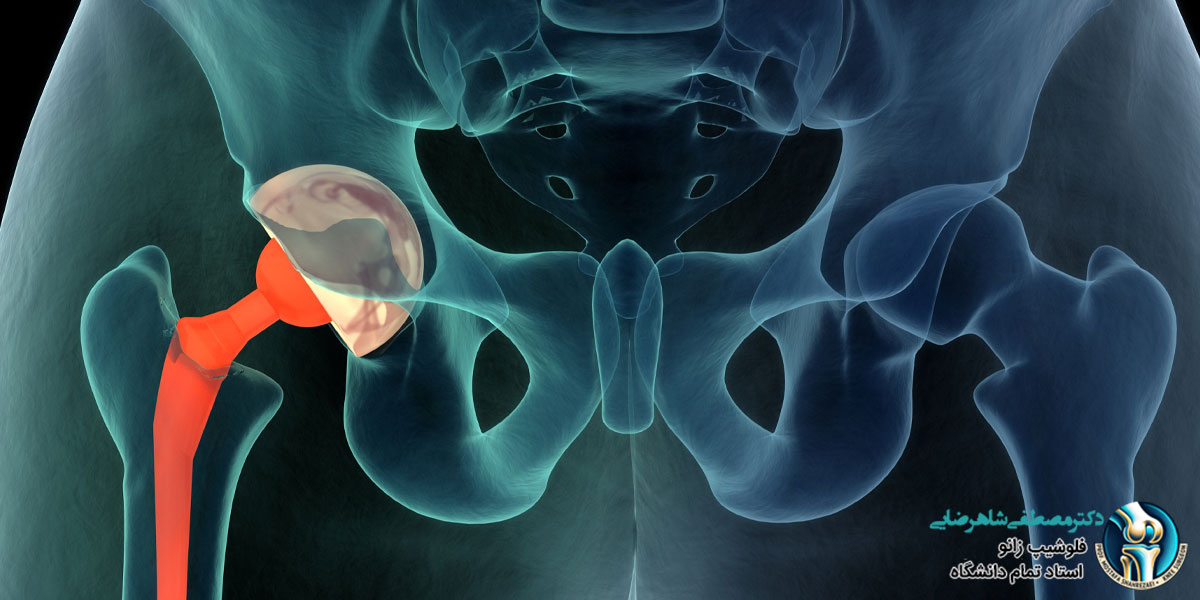 پروتز لگن چند سال عمر می کند