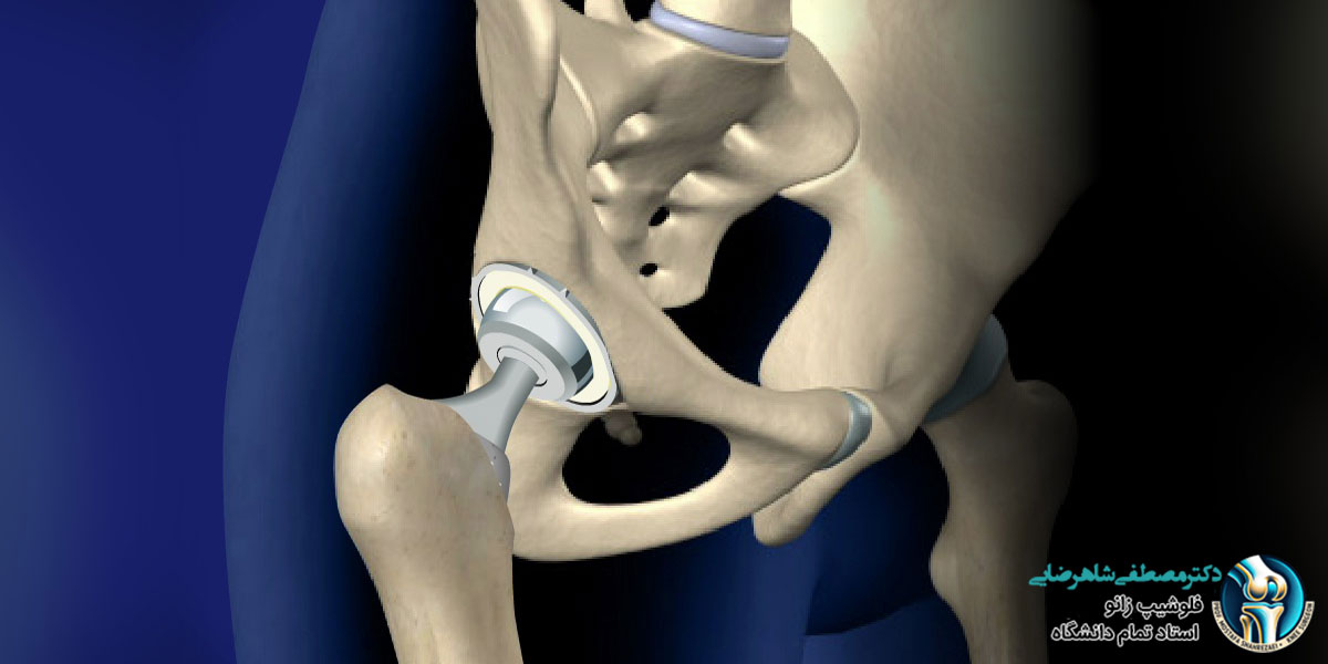 پروتز لگن چند سال عمر می کند
