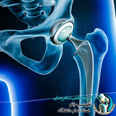 پروتز لگن چند سال عمر می کند